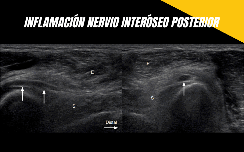 2. Nervio Interoeo Posterior Ecografia Tempo Formacion.png